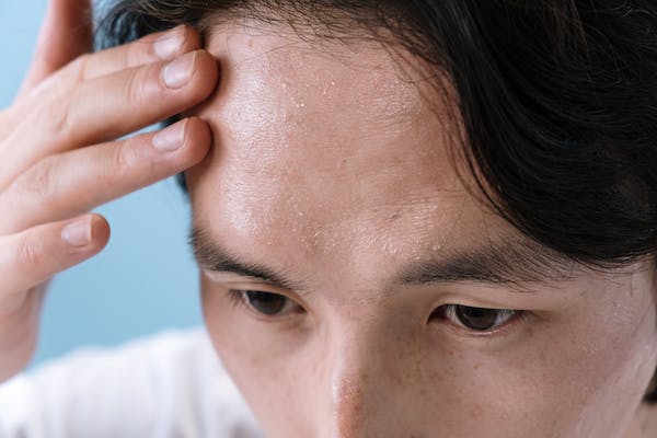 Stress reason for the Hair Loss - GetGoodLifeHacks